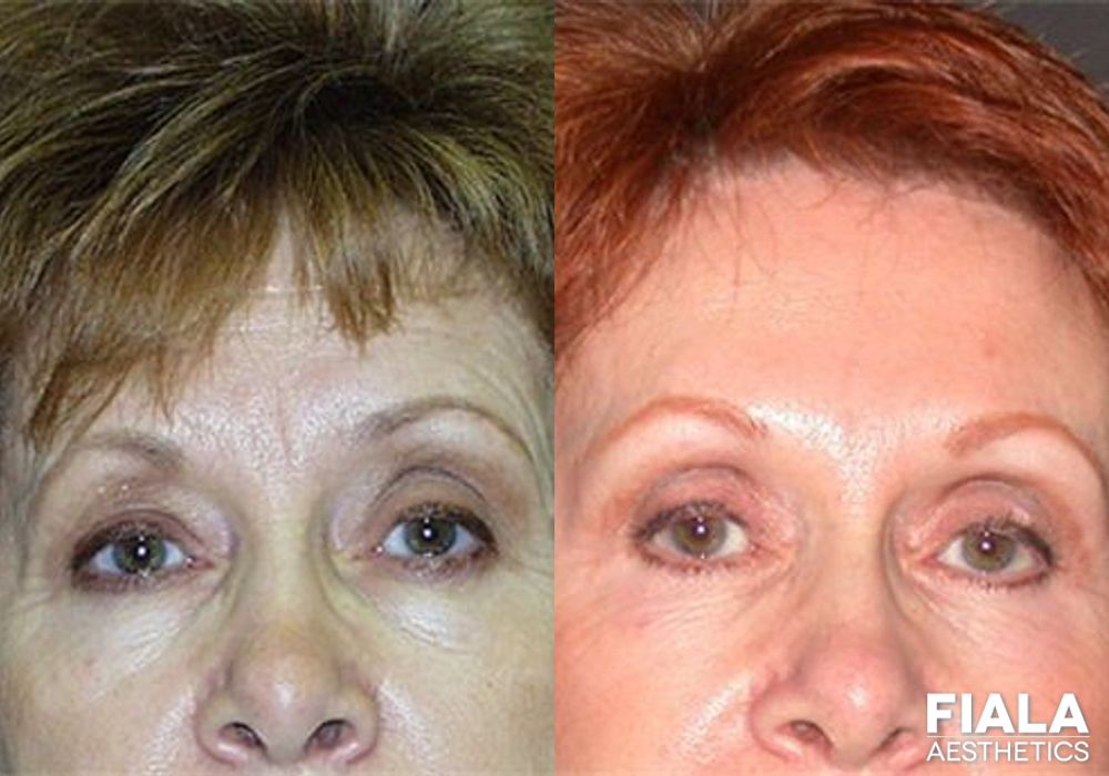 Before and after Forehead Lift case 13905