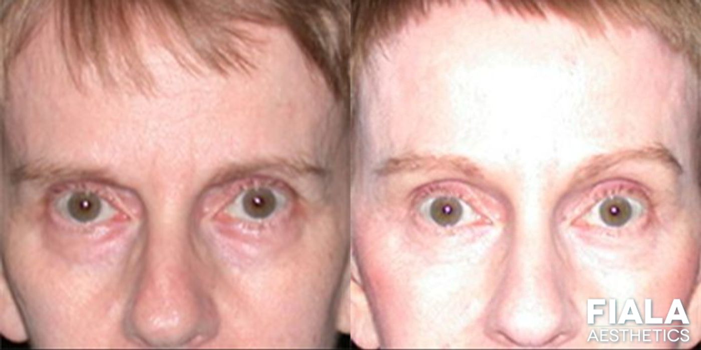 Before and after Forehead Lift case 13907