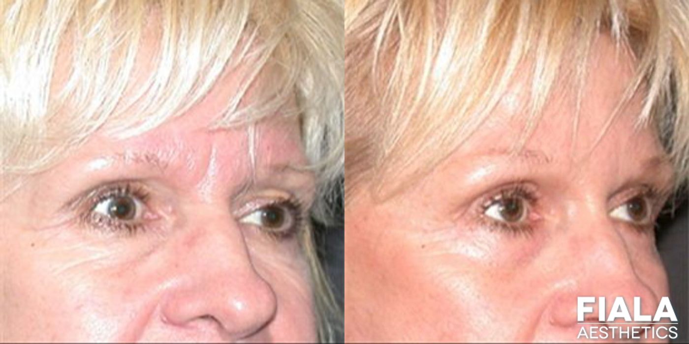 Forehead Lift - Thumbnail 2