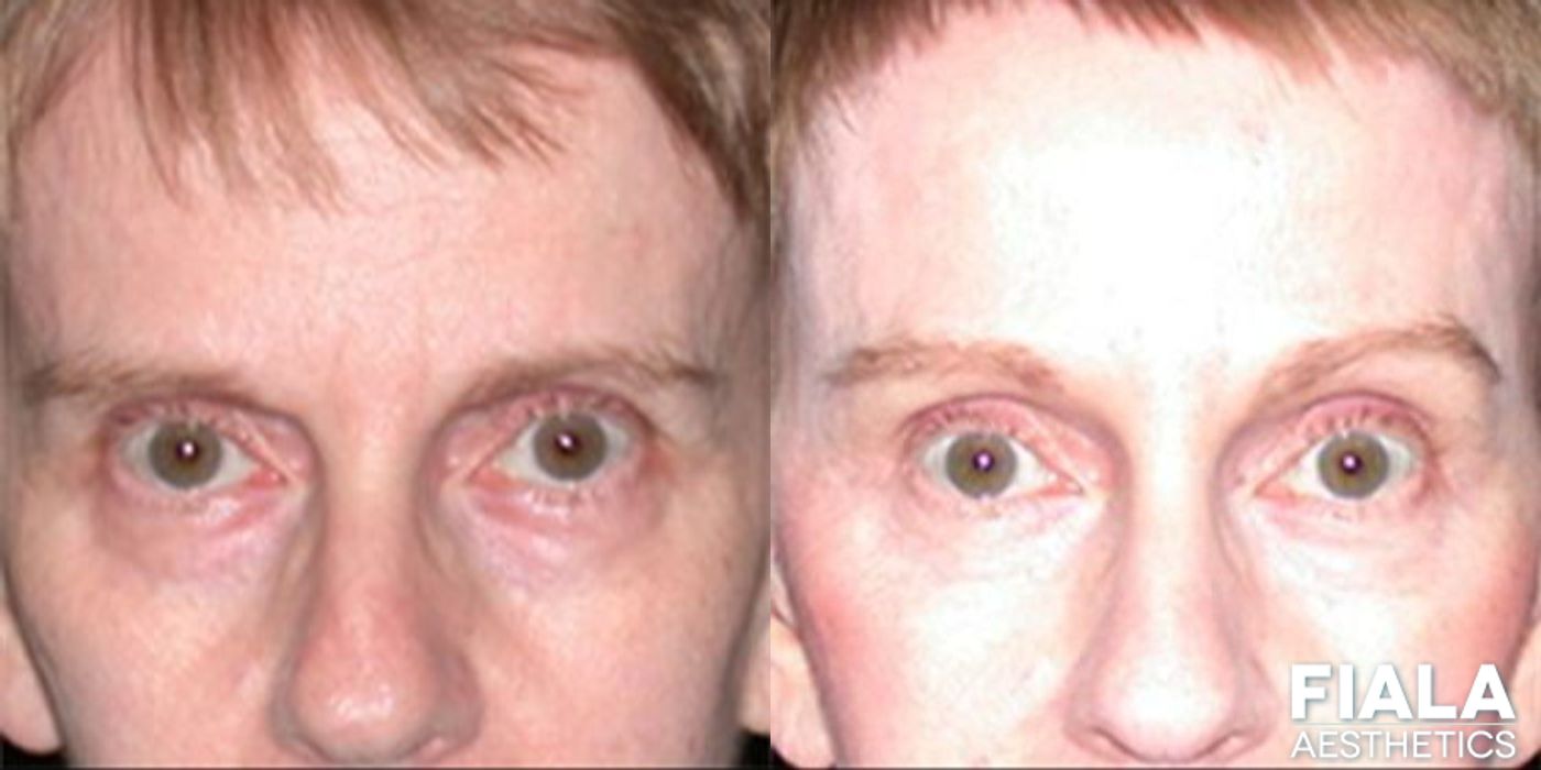 Forehead Lift - Case 9282