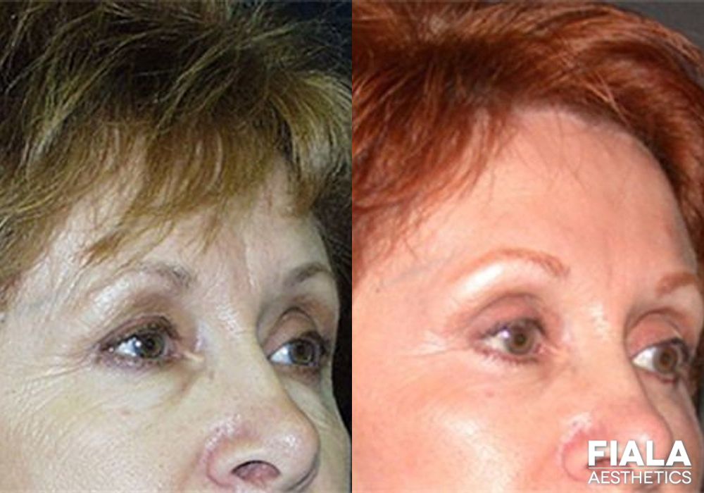 Before and after Forehead Lift case 13905 - Angle 2