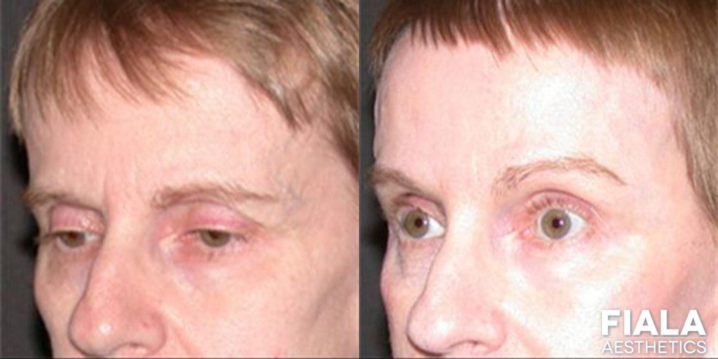 Forehead Lift - Thumbnail 2