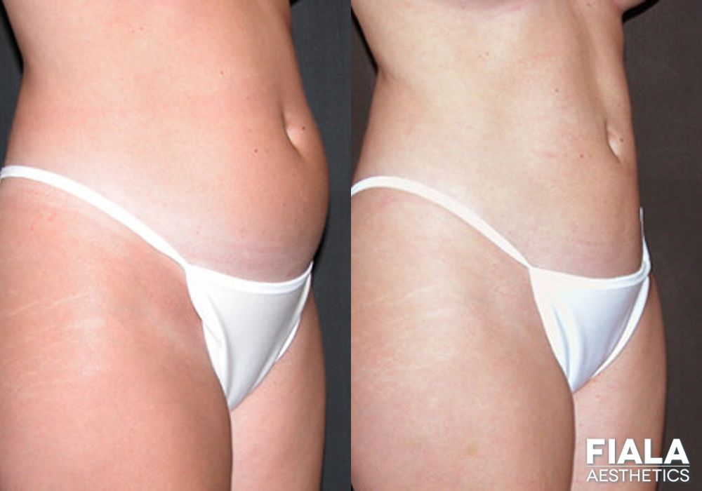 Before and after Liposuction/Liposculpture case 13802 - Angle 2