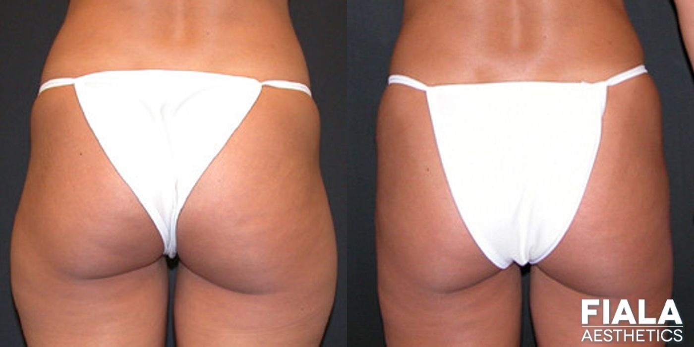 Liposuction/Liposculpture - Case 9057