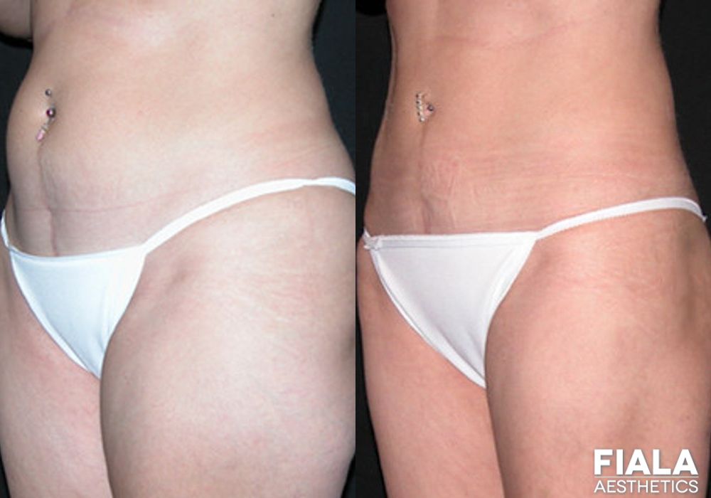 Liposuction/Liposculpture - Thumbnail 2