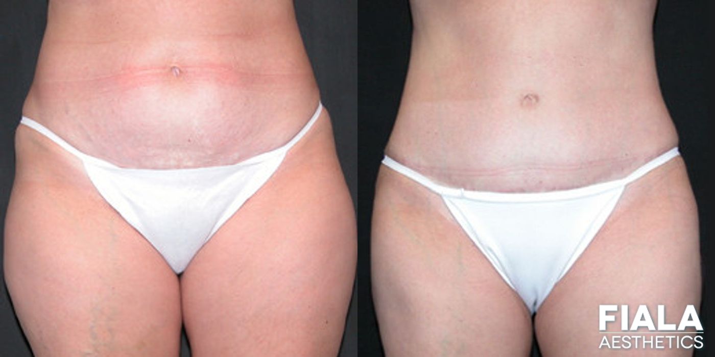 Before and after Liposuction/Liposculpture case 13804
