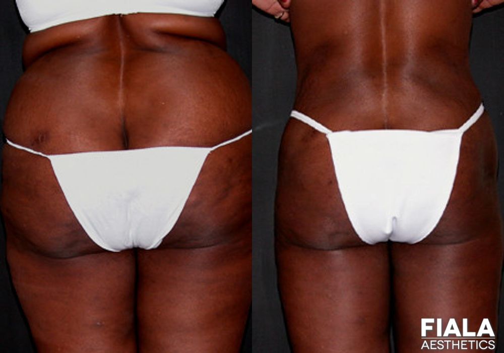 Liposuction/Liposculpture - Case 8880
