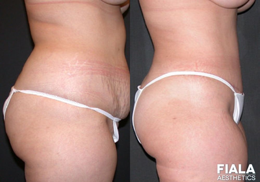 Liposuction/Liposculpture - Thumbnail 2