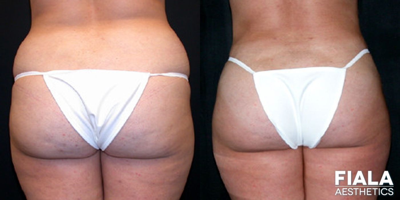Before and after Liposuction/Liposculpture case 13805