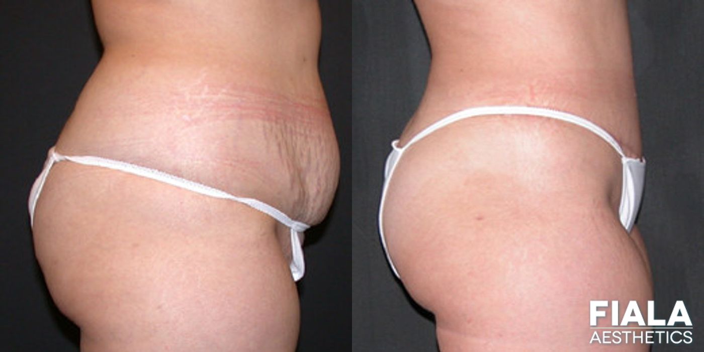 Before and after Liposuction/Liposculpture case 13805 - Angle 2