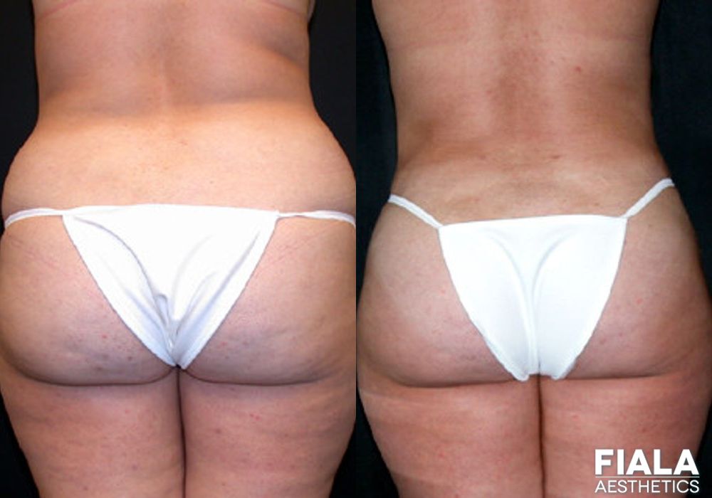 Liposuction/Liposculpture - Case 8878