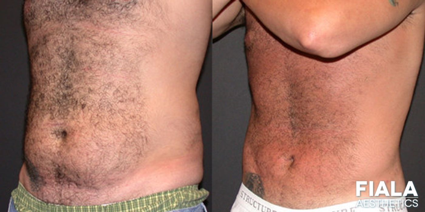 Before and after Liposuction/Liposculpture case 13811