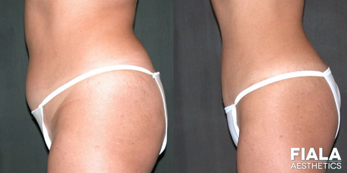 Before and after Liposuction/Liposculpture case 13806 - Angle 2
