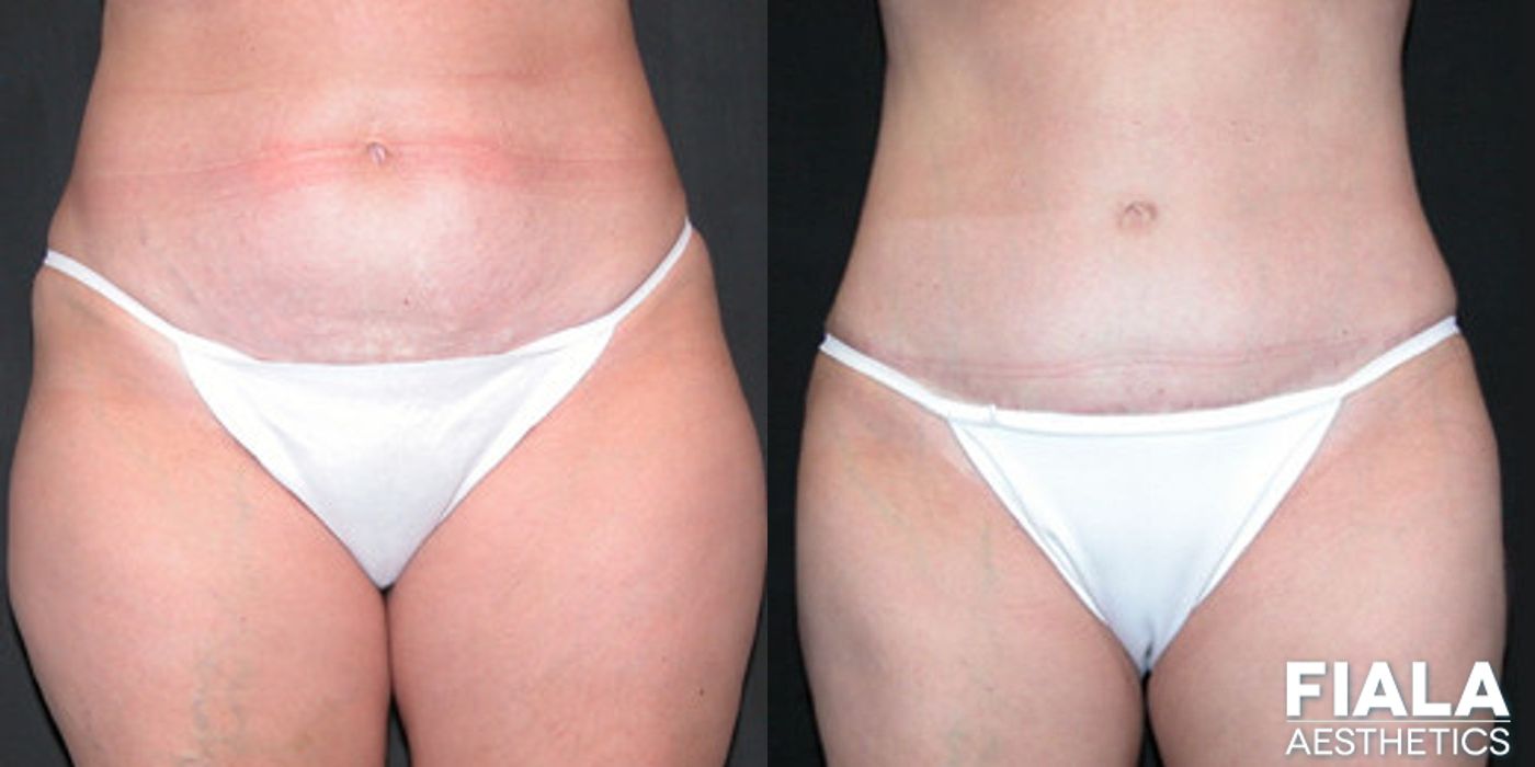 Liposuction/Liposculpture - Case 9060
