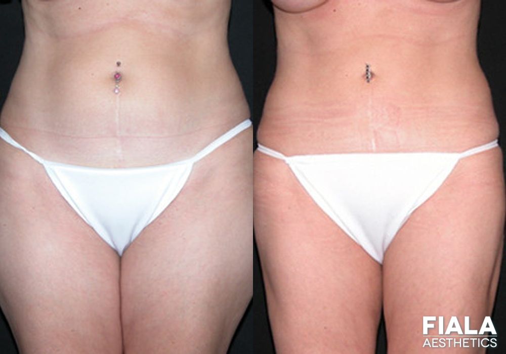 Before and after Liposuction/Liposculpture case 13803