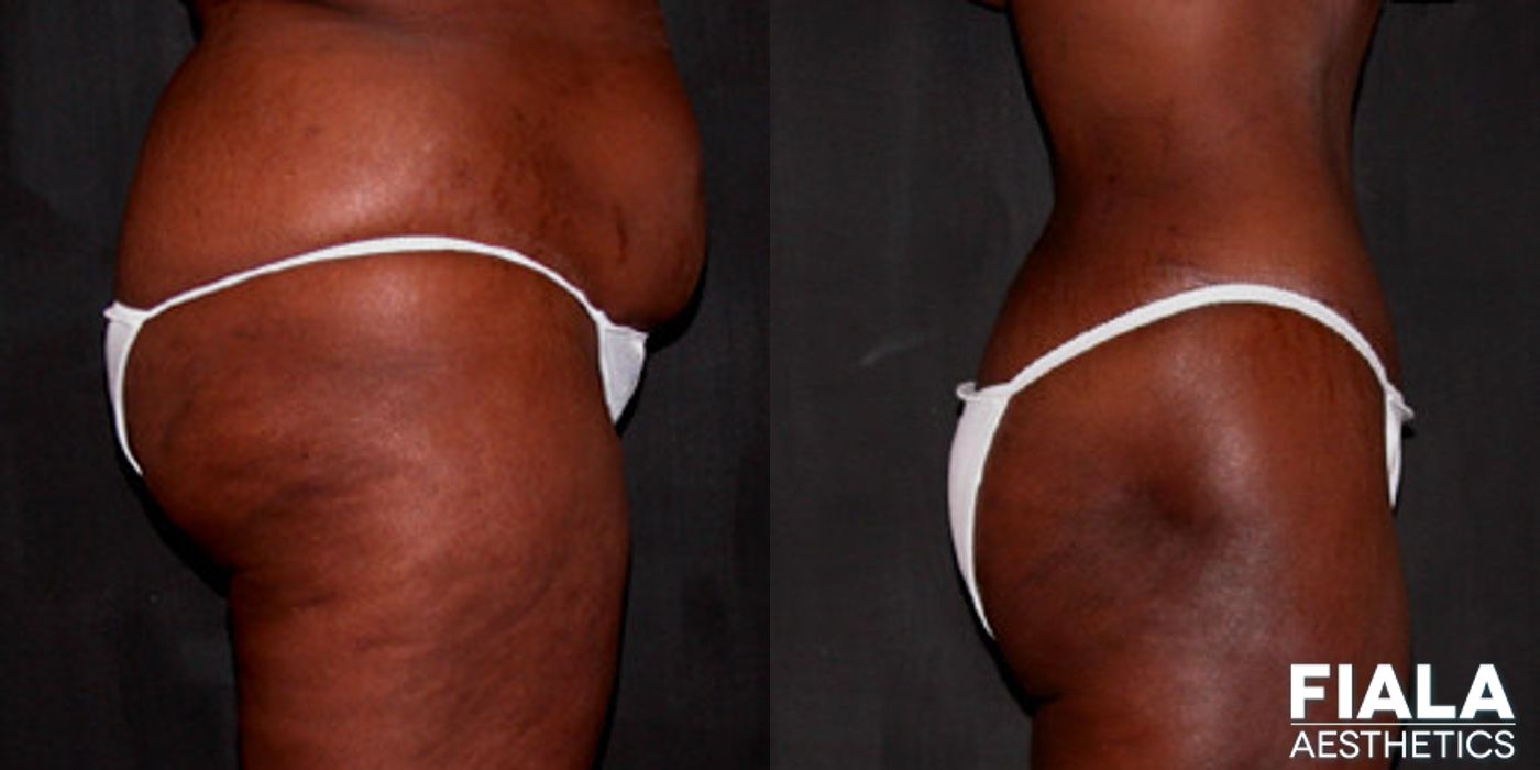 Liposuction/Liposculpture - Thumbnail 2