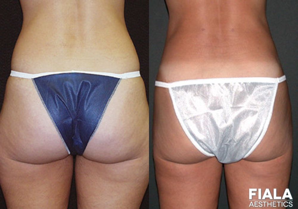 Liposuction/Liposculpture - Case 8882