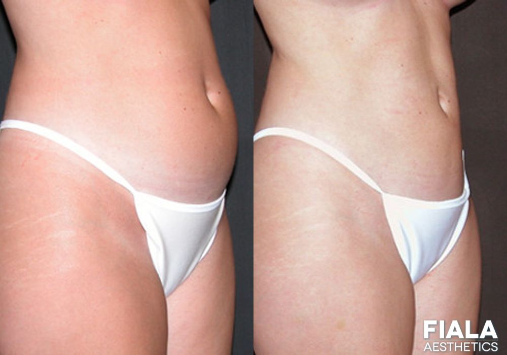 Liposuction/Liposculpture - Thumbnail 2