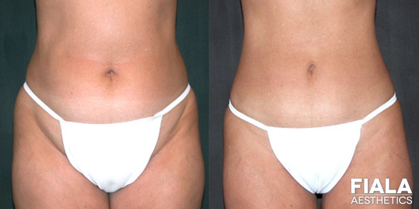 Before and after Liposuction/Liposculpture case 13800