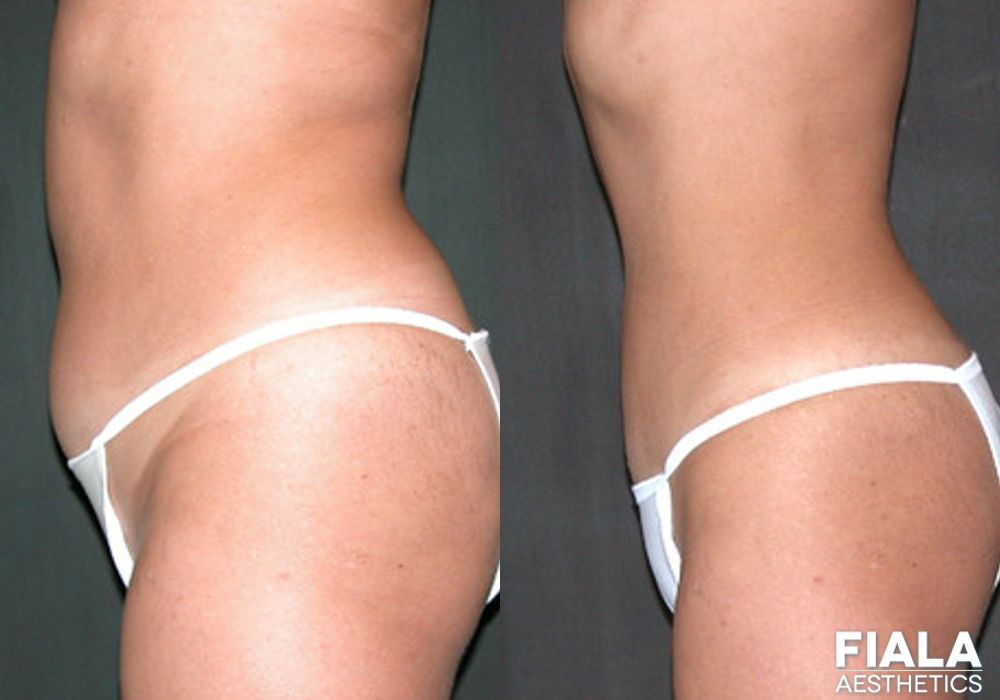 Liposuction/Liposculpture - Thumbnail 2