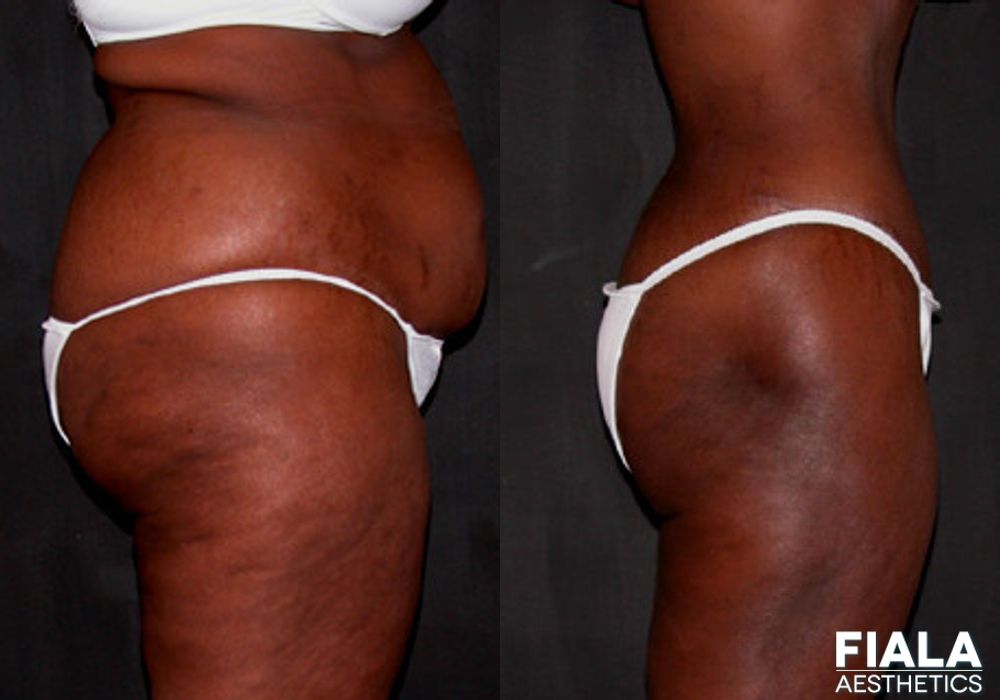 Liposuction/Liposculpture - Thumbnail 2