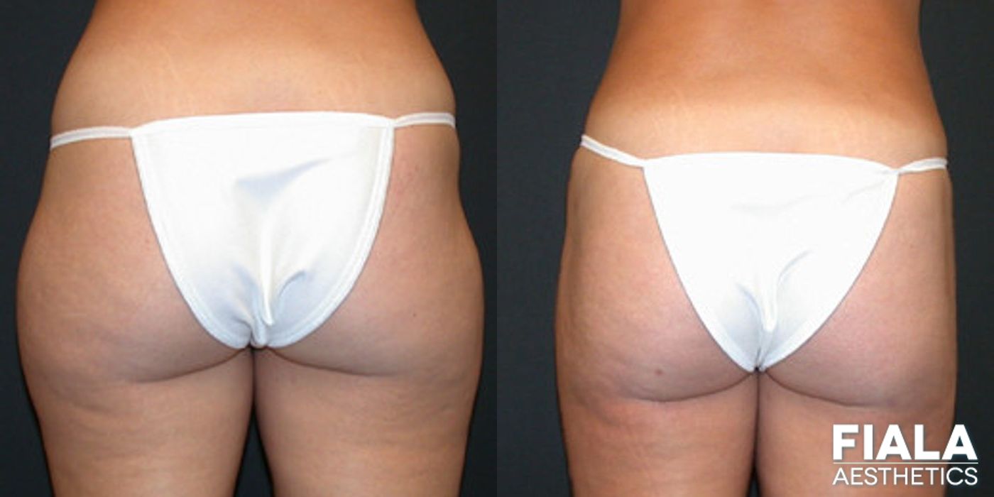 Before and after Liposuction/Liposculpture case 13800 - Angle 2