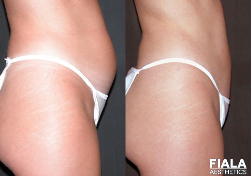 Liposuction/Liposculpture - Case 9058