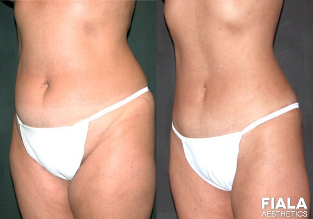 Liposuction/Liposculpture - Case 8879