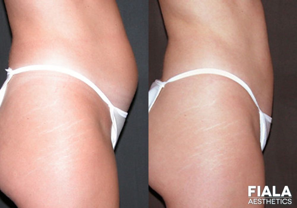 Before and after Liposuction/Liposculpture case 13802