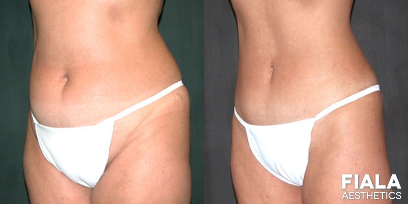 Before and after Liposuction/Liposculpture case 13806