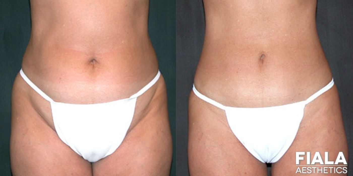 Liposuction/Liposculpture - Case 9056