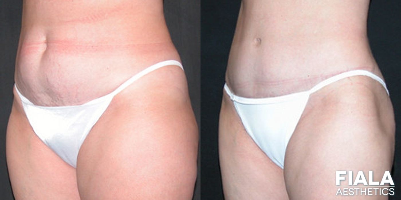 Before and after Liposuction/Liposculpture case 13804 - Angle 2