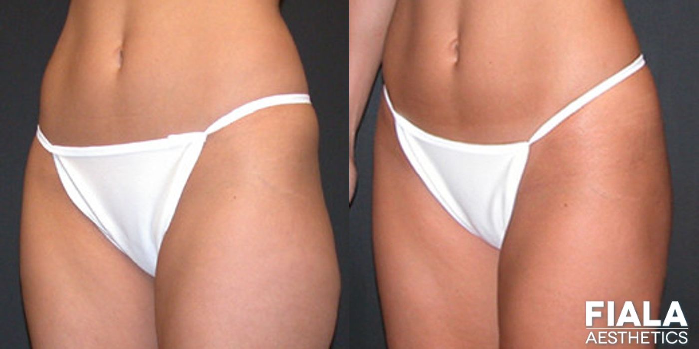 Liposuction/Liposculpture - Thumbnail 2