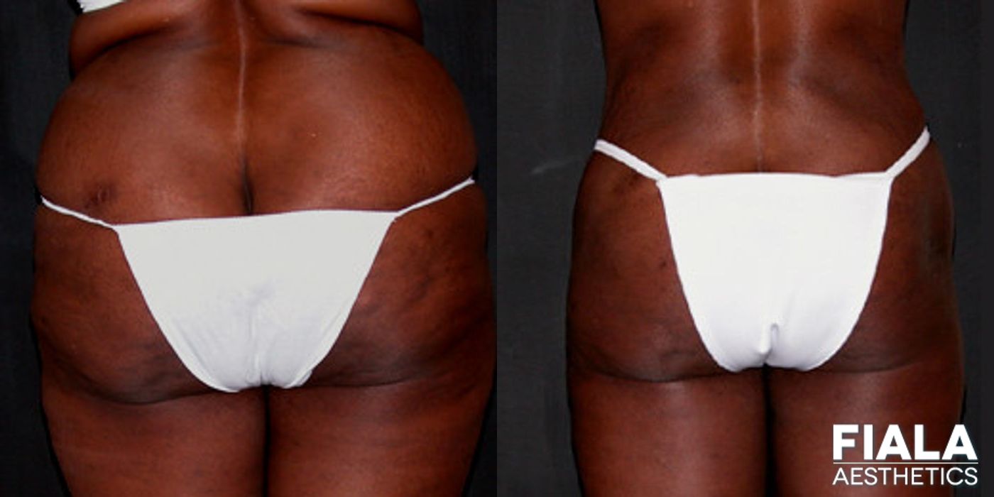 Before and after Liposuction/Liposculpture case 13808