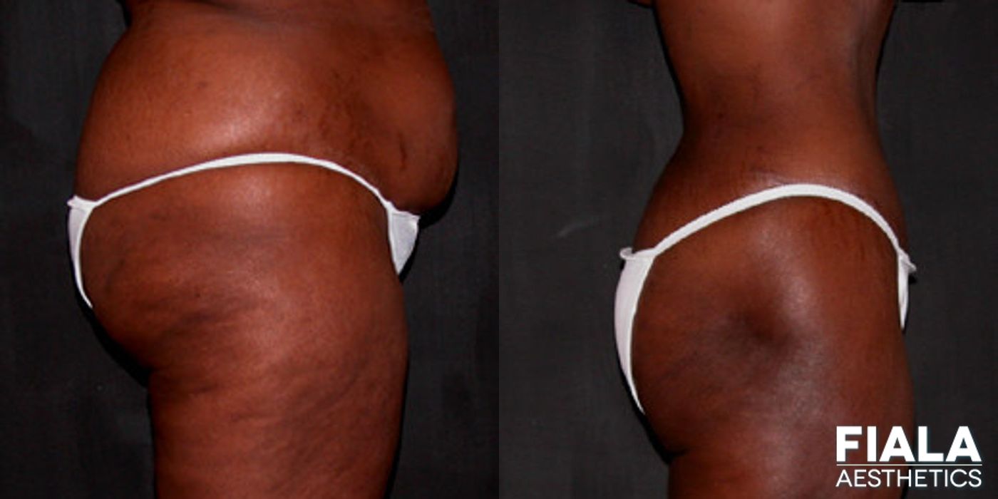 Before and after Liposuction/Liposculpture case 13808 - Angle 2