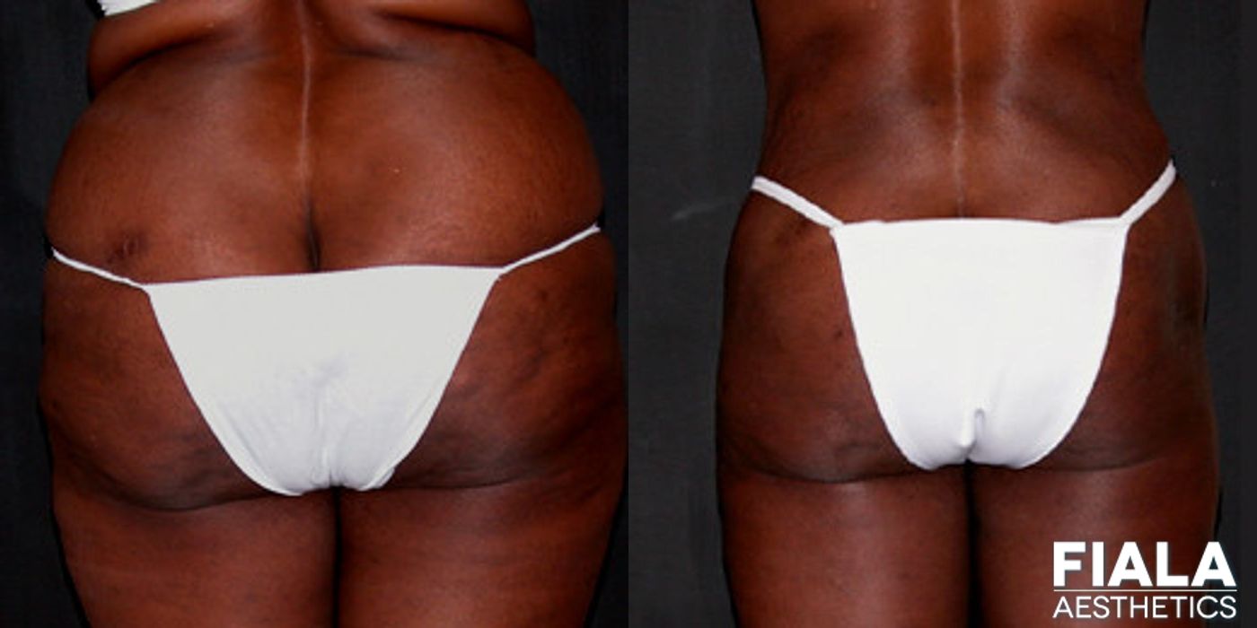 Liposuction/Liposculpture - Case 9063