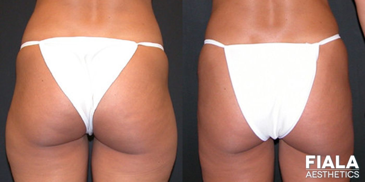 Before and after Liposuction/Liposculpture case 13801