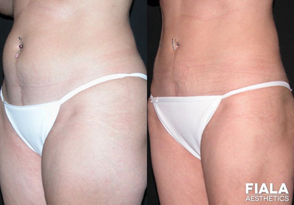 Before and after Liposuction/Liposculpture case 13803 - Angle 2