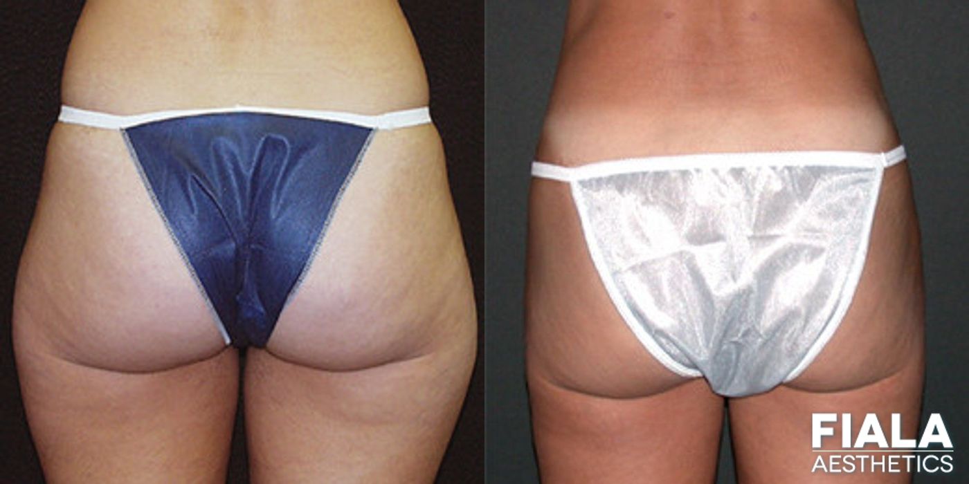 Before and after Liposuction/Liposculpture case 13812