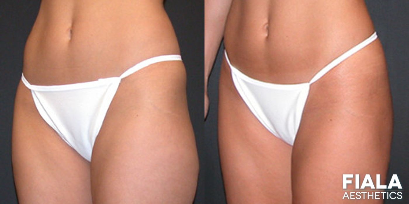 Before and after Liposuction/Liposculpture case 13801 - Angle 2