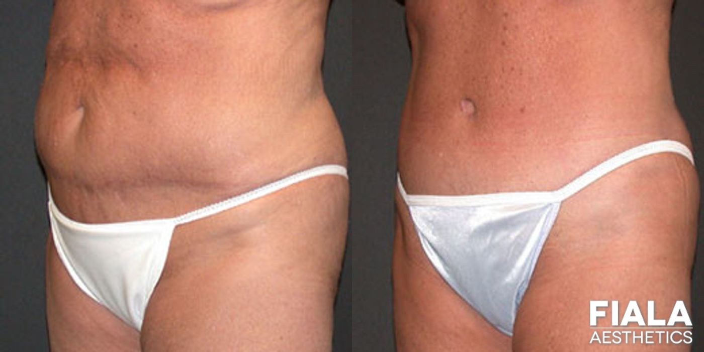Before and after Tummy Tuck case 13822 - Angle 2
