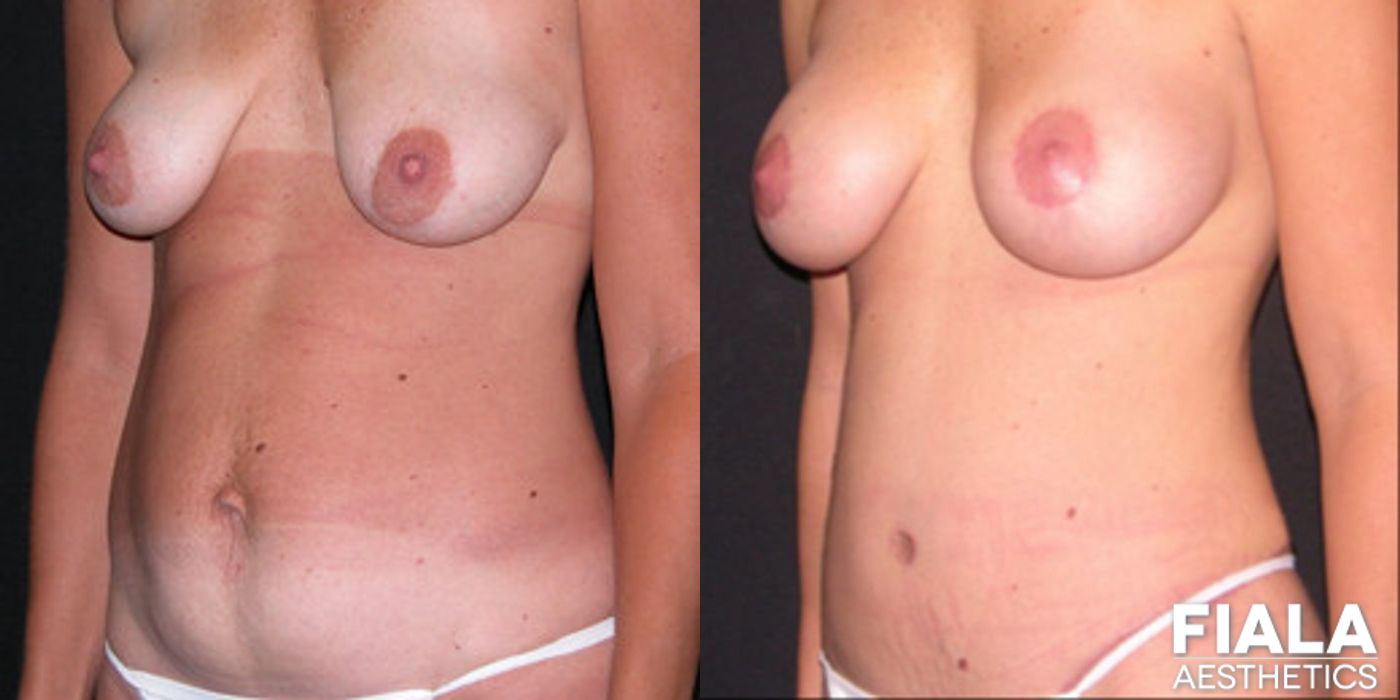 Breast Lift - Thumbnail 2