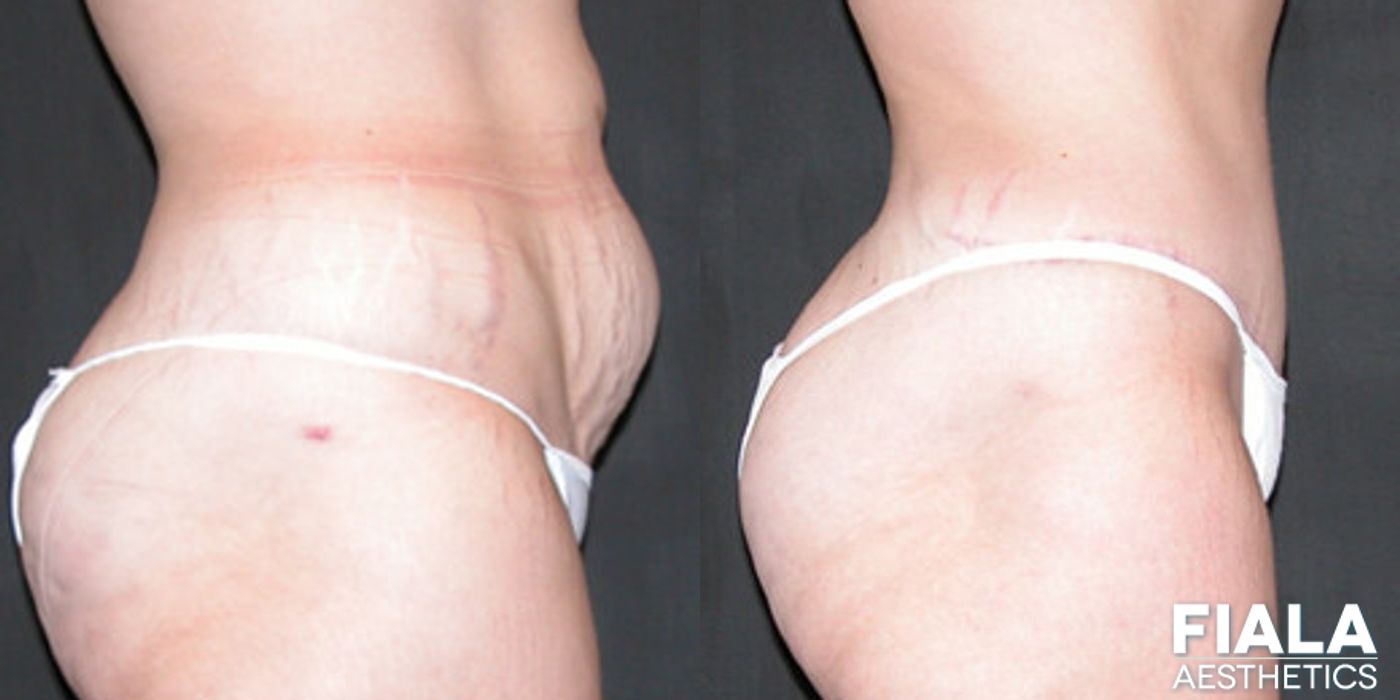 Tummy Tuck - Thumbnail 2