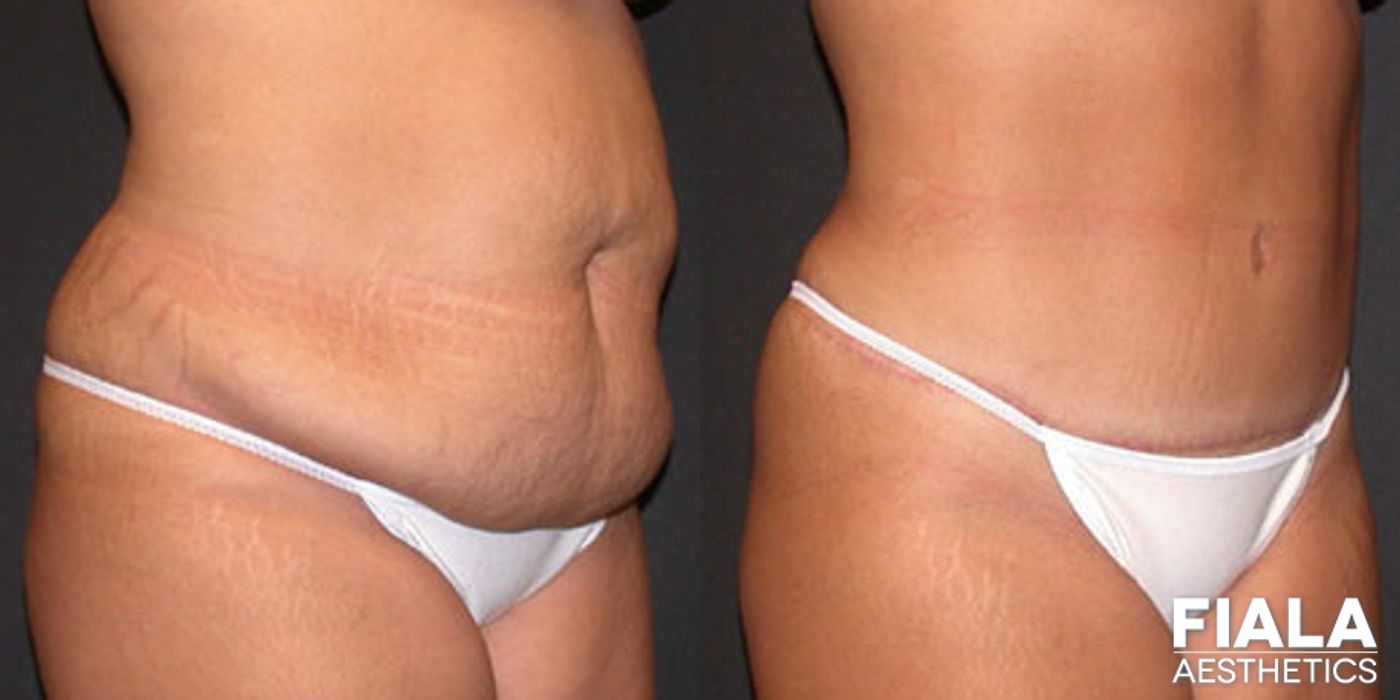 Before and after Tummy Tuck case 13843