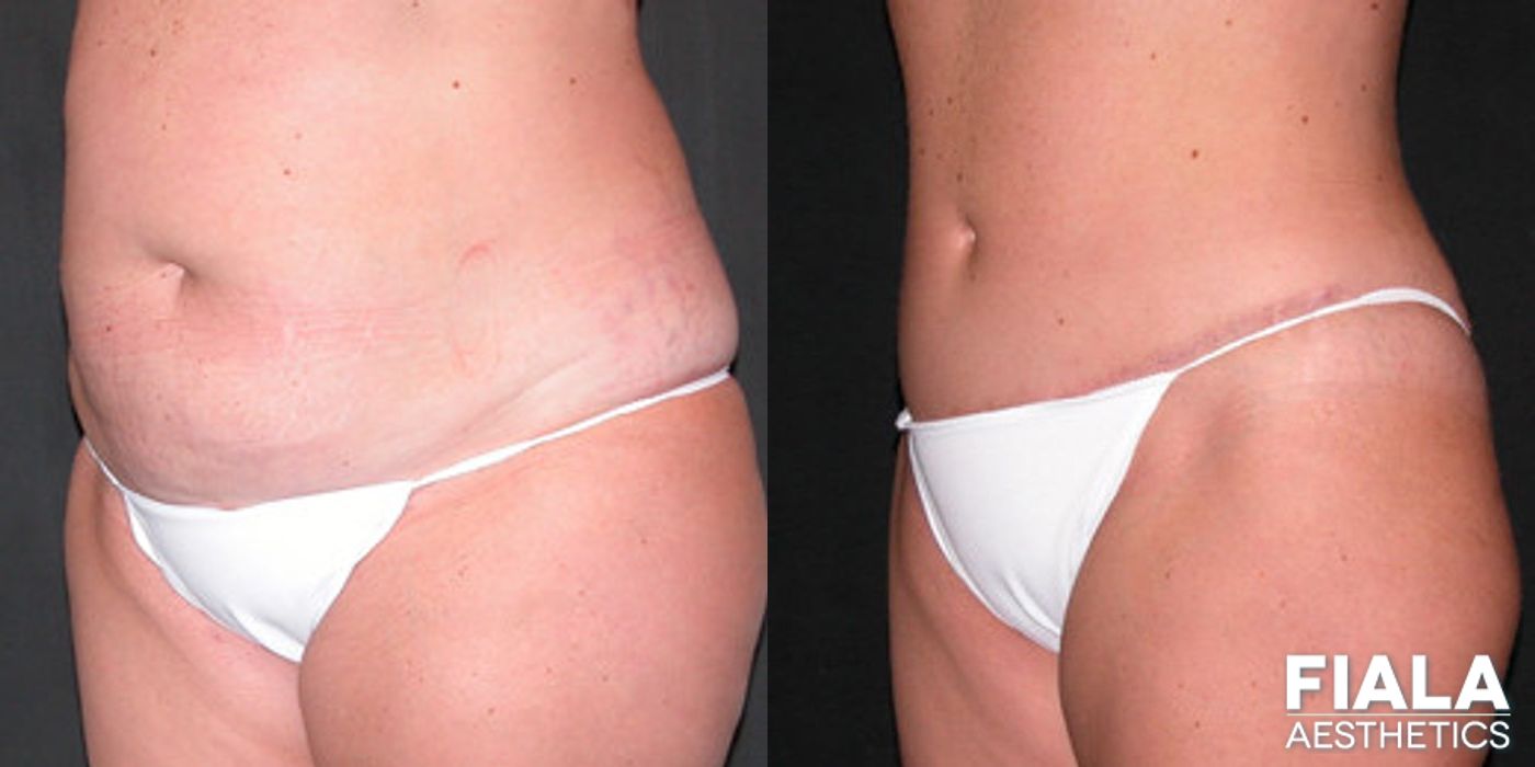 Before and after Tummy Tuck case 13834 - Angle 2