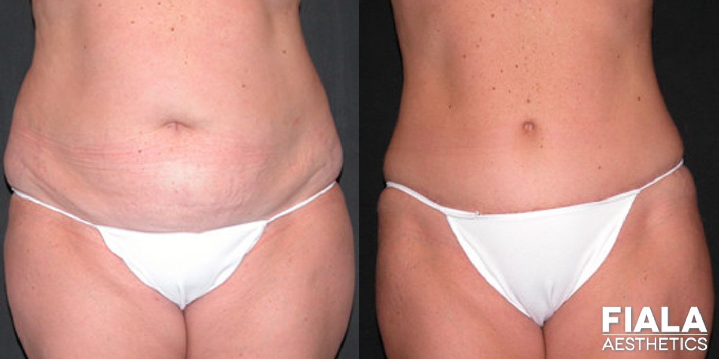 Before and after Tummy Tuck case 13834