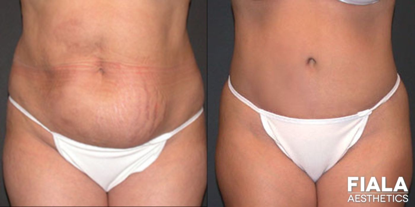 Before and after Tummy Tuck case 13828