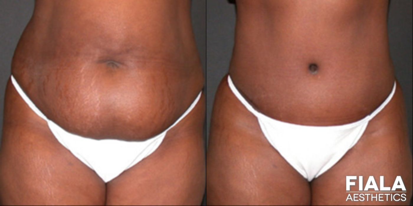 Before and after Tummy Tuck case 13813