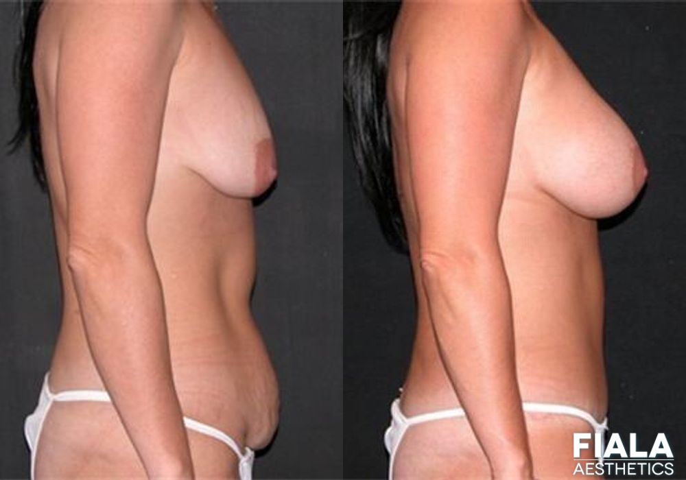 Breast Lift - Thumbnail 2