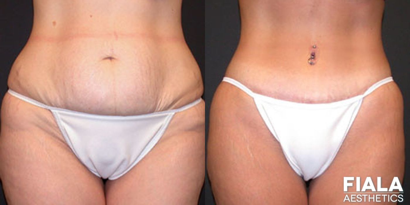 Before and after procedure result